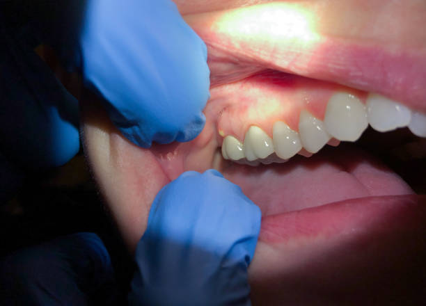 Best Emergency Dentist for Special Needs Patients in Youngstown, NY