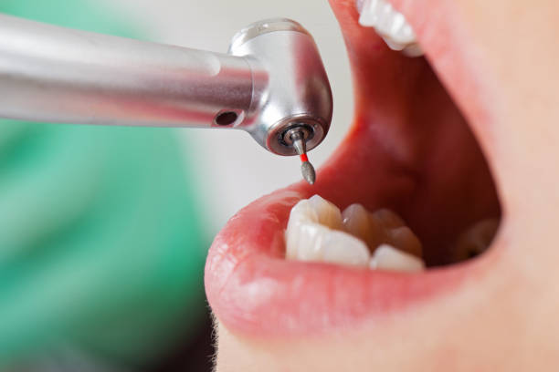 Best Emergency Dentist for Knocked-Out Tooth in Youngstown, NY